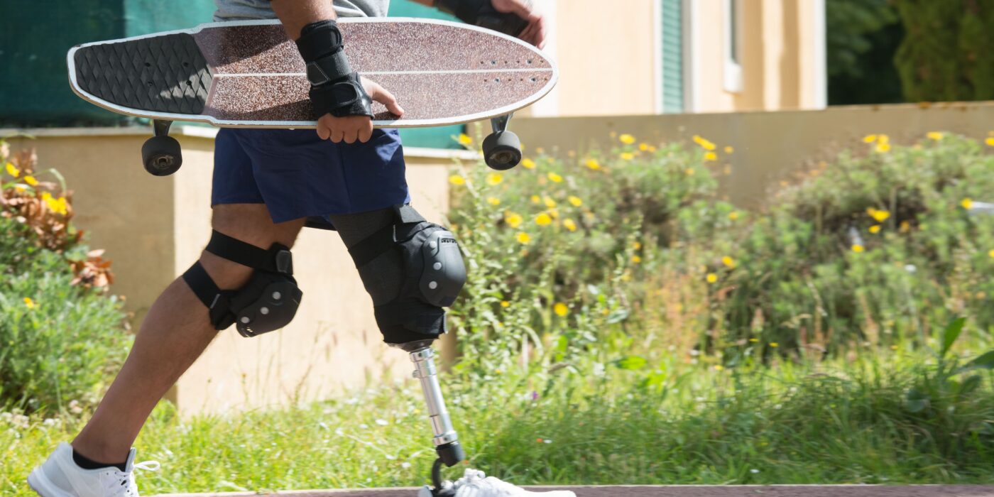 Getting Socket Fit Right: A Practical Guide to Pressure Management in Lower-Limb Prosthetics
